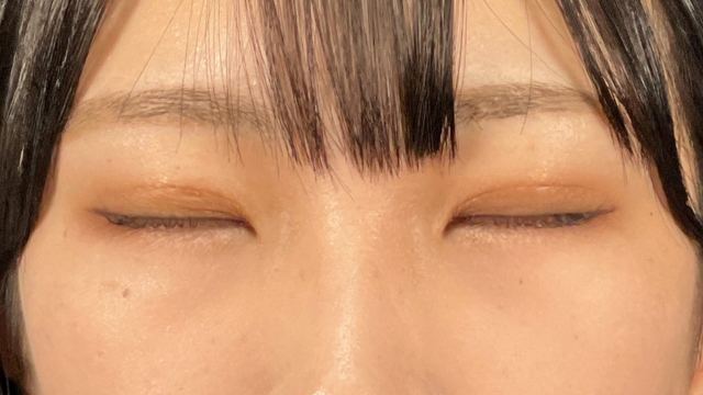 手術前の状態 その1