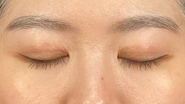 手術前の状態 その1