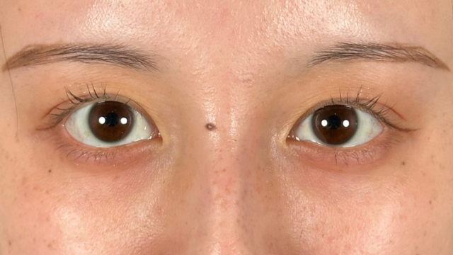 手术前的状态 其一