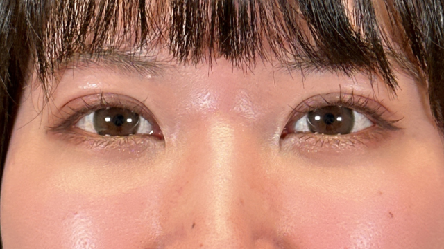 手術前の状態 その1