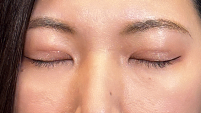 手術前の状態 その1