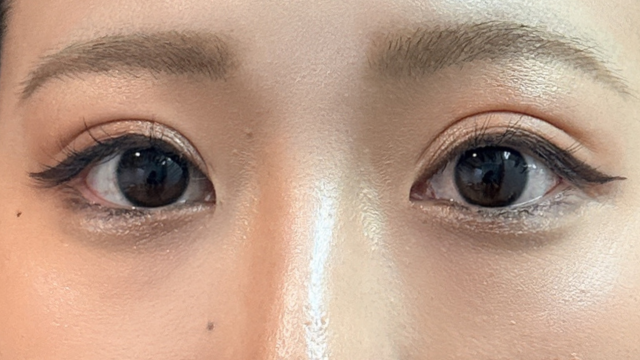 手術前の状態 その1