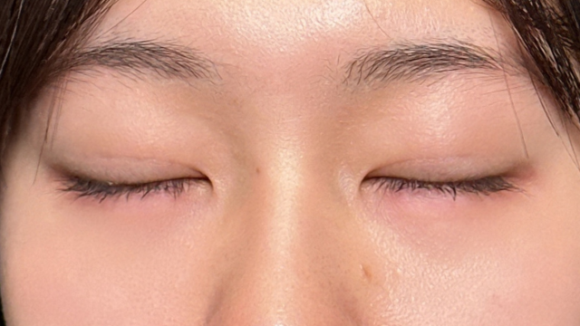 手术前的状态 其一