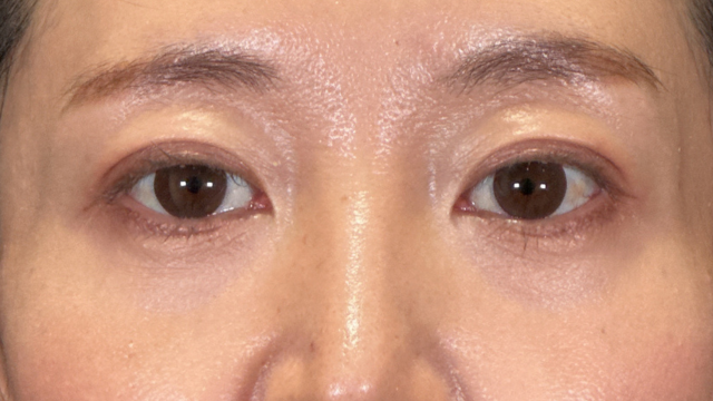 手術前の状態 その1