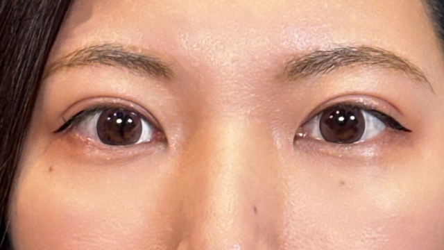 手術前の状態 その1