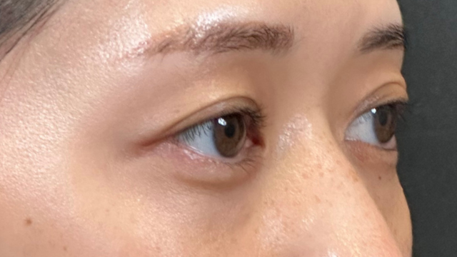 手術前の状態 その1