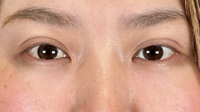 手术前的状态 其一