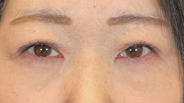 手术前的状态 其一