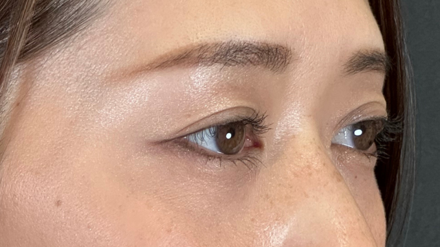 手術前の状態 その1