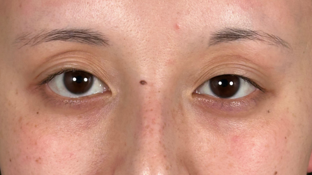 手术前的状态 其一