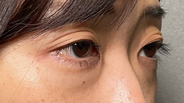 手术前的状态 其一