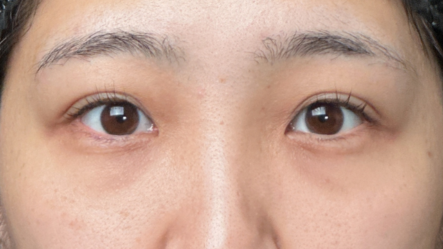 手术前的状态 其一