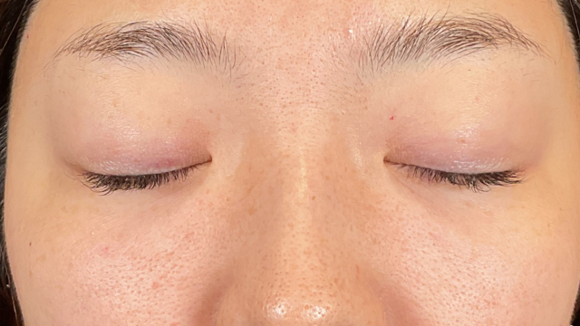 手术前的状态 其一