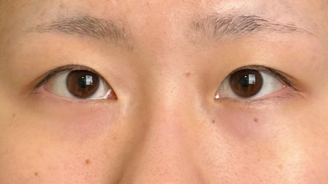 手术前的状态 其一