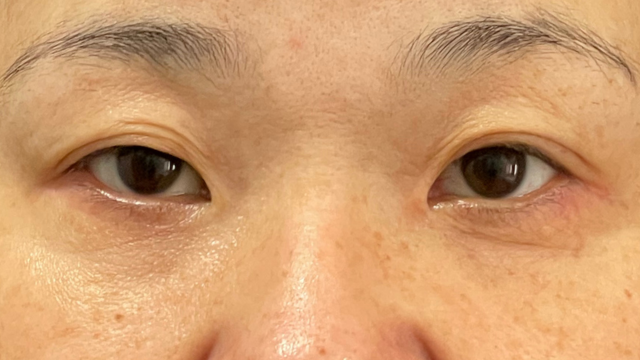 手术前的状态 其一