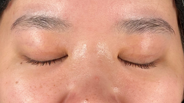 手术前的状态 其一