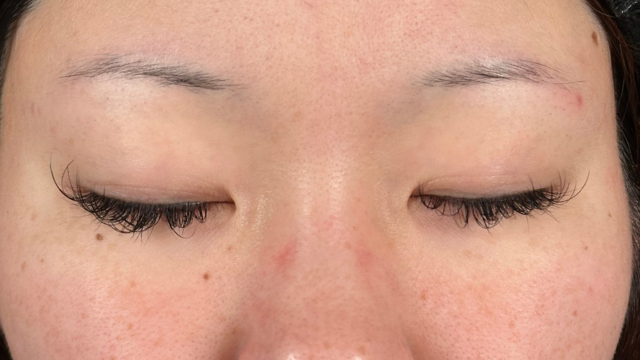 手术前的状态 其一