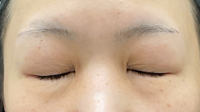 手术前的状态 其一