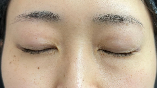 手术前的状态 其一