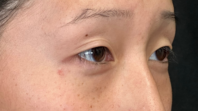 手术前的状态 其一