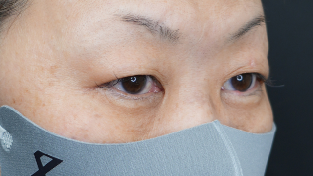 手术前的状态 其一