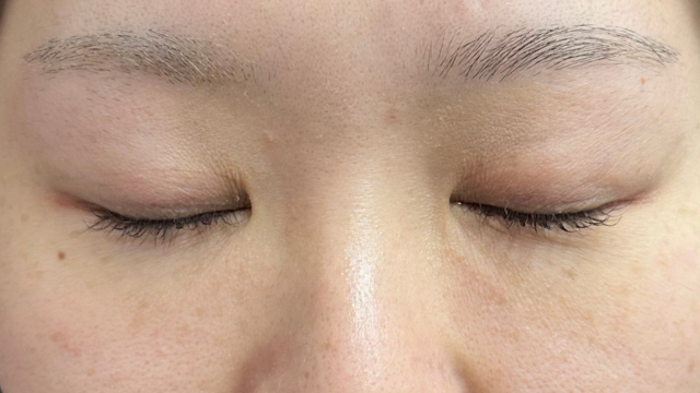 手术前的状态 其一