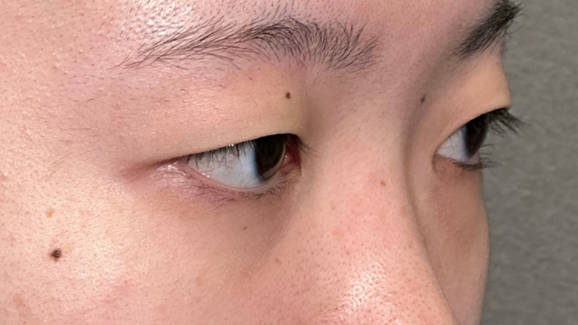 手术前的状态 其一