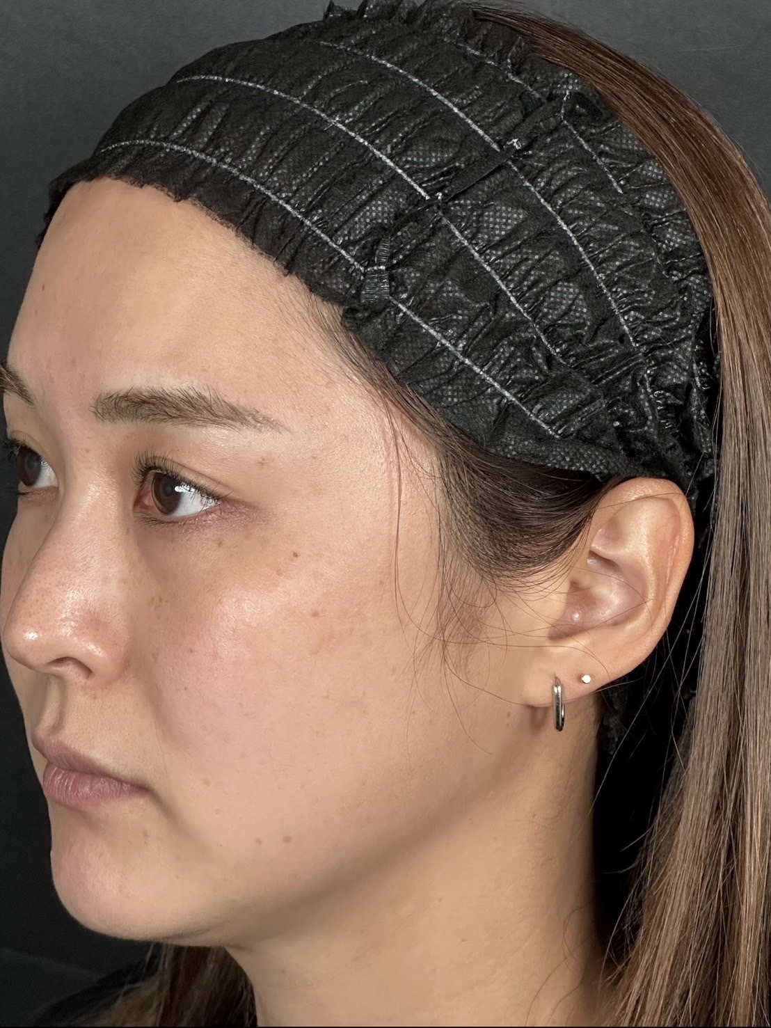 手术前的状态 其一