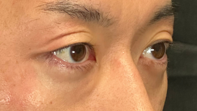 手术前的状态 其一