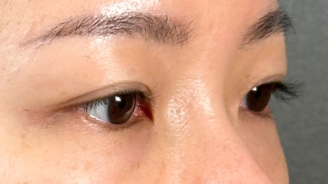 手术前的状态 其一