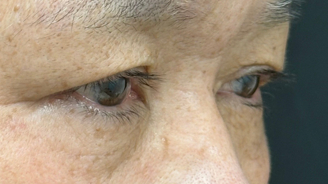 手术前的状态 其一