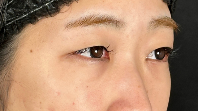 手术前的状态 其一