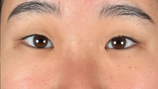 手术前的状态 其一