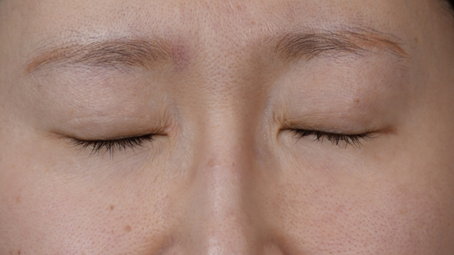 手术前的状态 其一