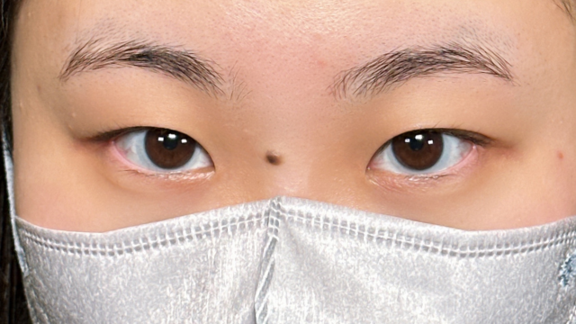 手术前的状态 其一