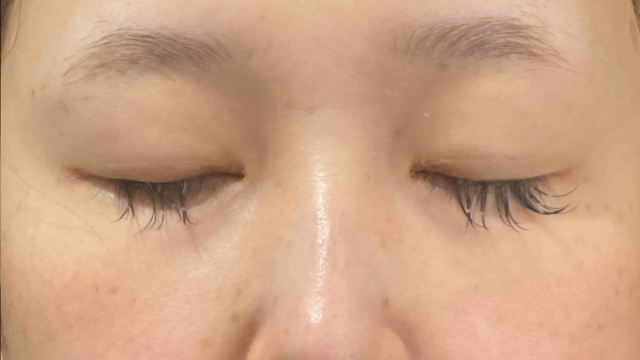 手术前的状态 其一