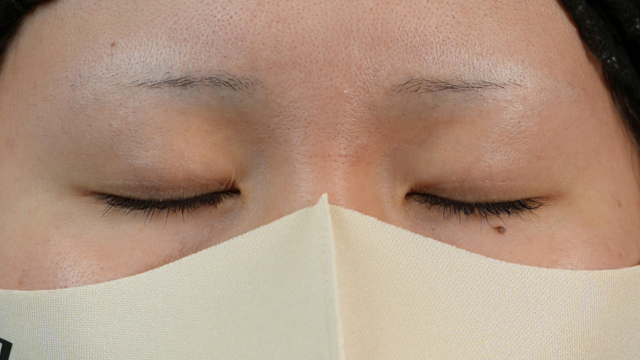 手术前的状态 其一