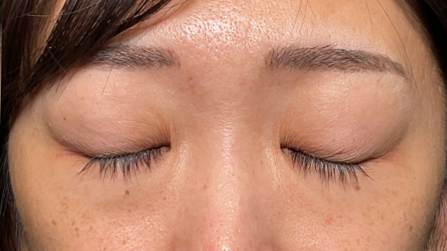 手术前的状态 其一