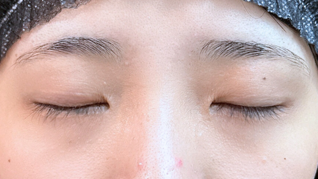 手术前的状态 其一