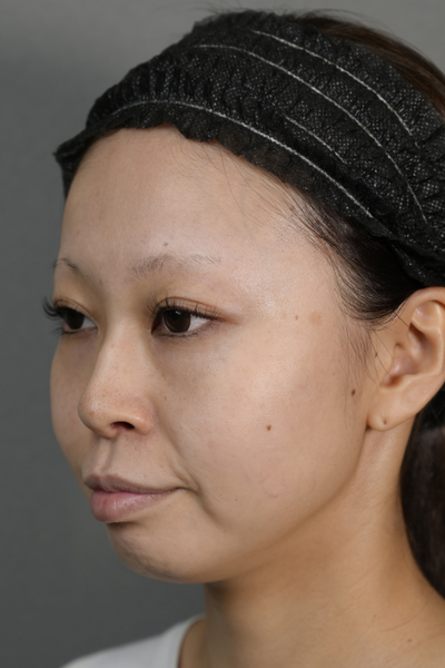 手术前的状态 其一