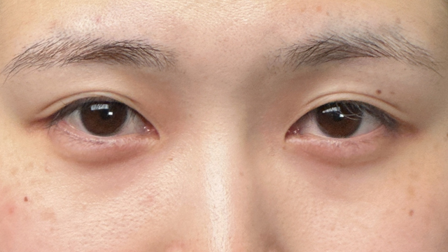 手术前的状态 其一