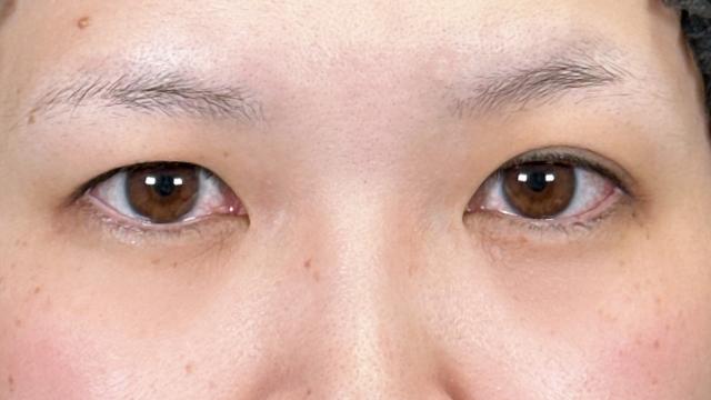 手术前的状态 其一