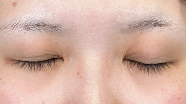 手术前的状态 其一