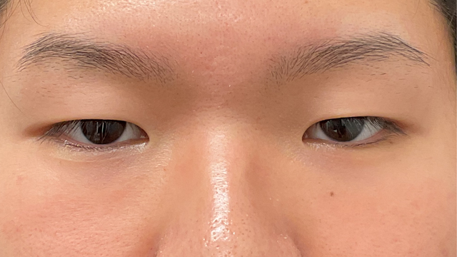 手术前的状态 其一