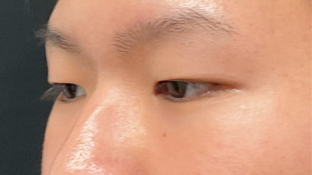 手术前的状态 其一