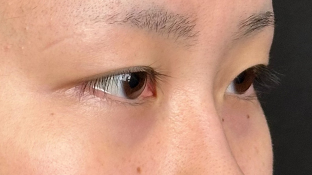 手术前的状态 其一