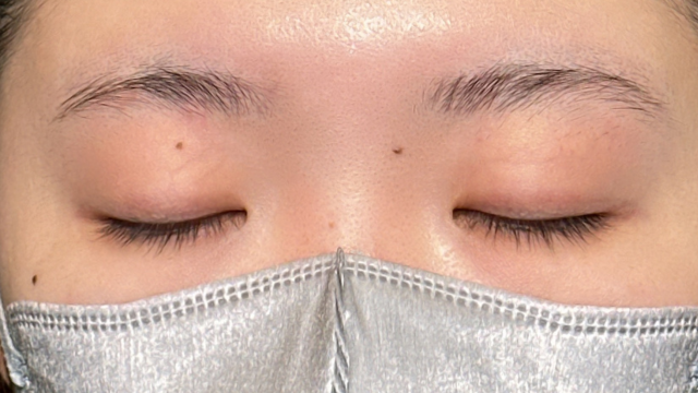 手术前的状态 其一