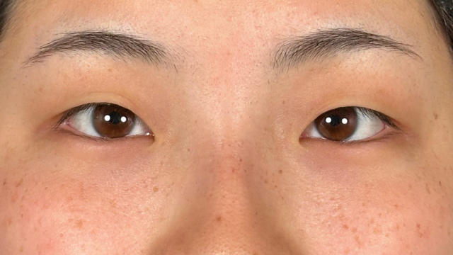 手术前的状态 其一