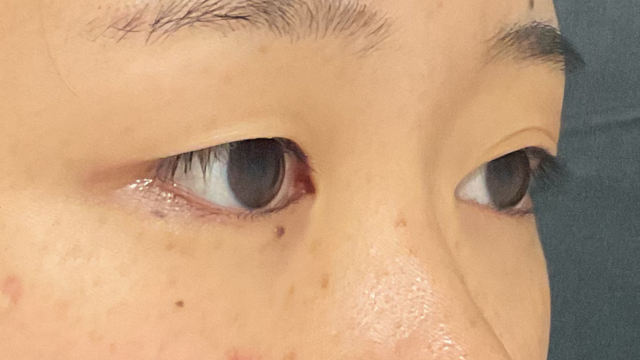 手术前的状态 其一