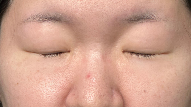 手术前的状态 其一